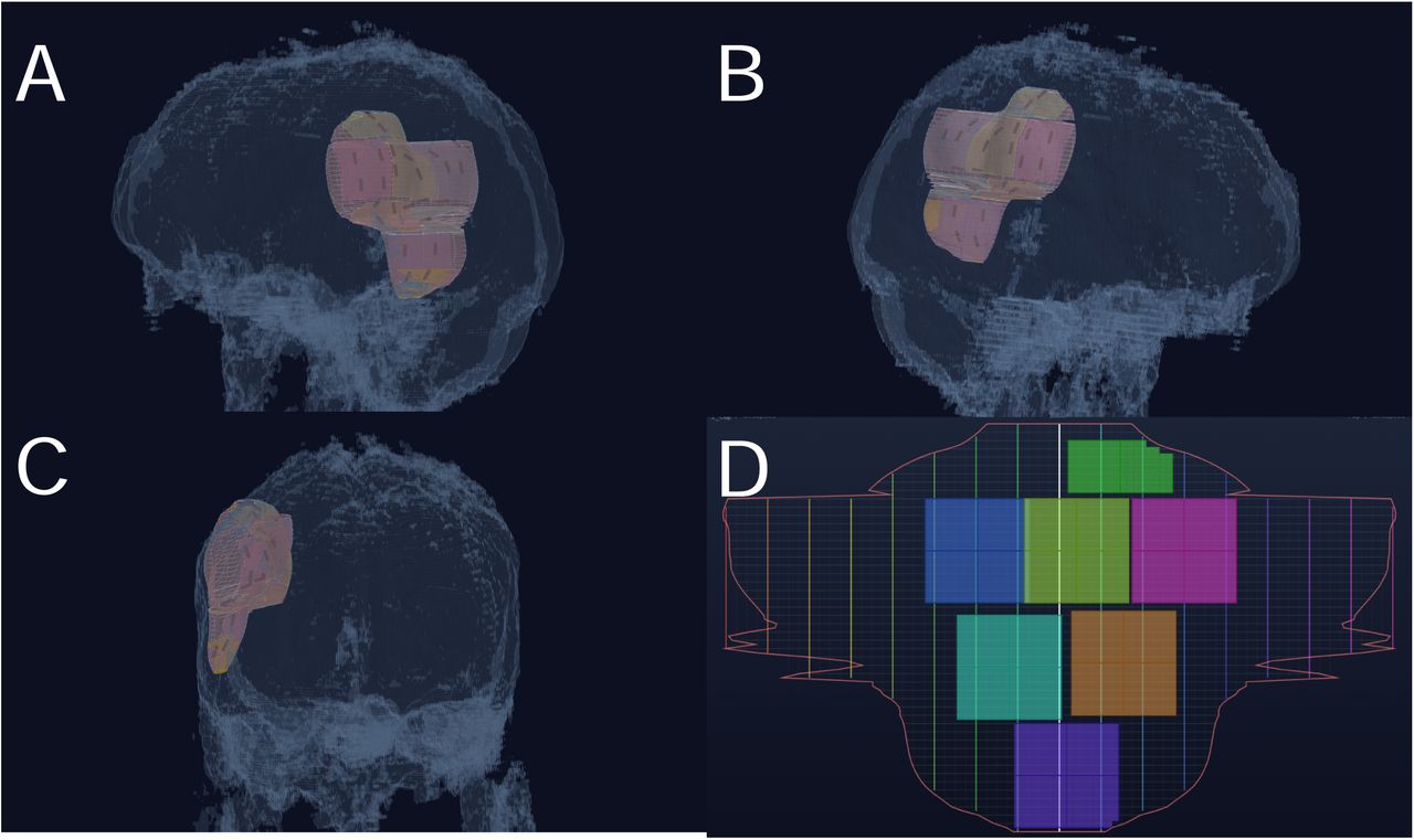 BrachyAtlas virtual tile placement in three dimensions and on the opened planning map