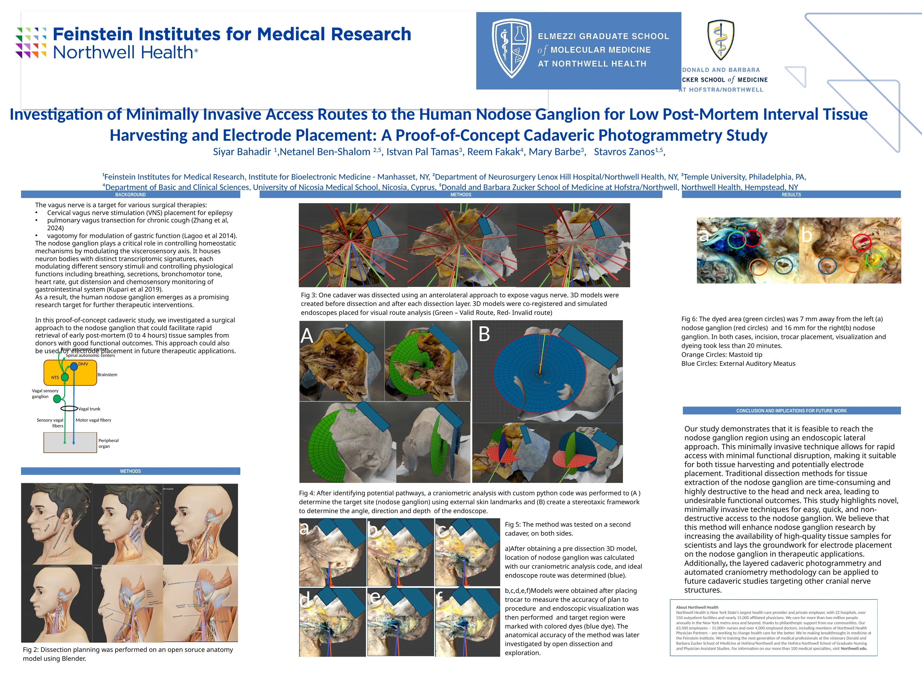 Minimally invasive access to the human nodose ganglion — original research poster with author credits and figures